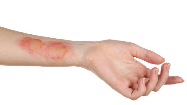 烫烧伤分级示意图